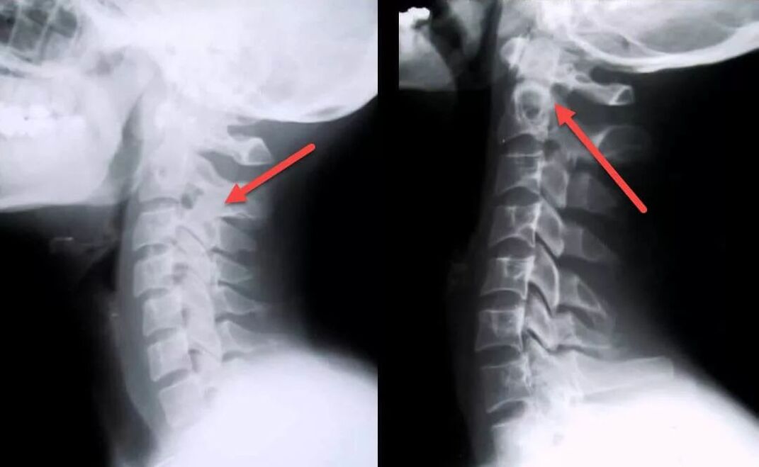 Diagnosi dell'osteocondrosi cervicale