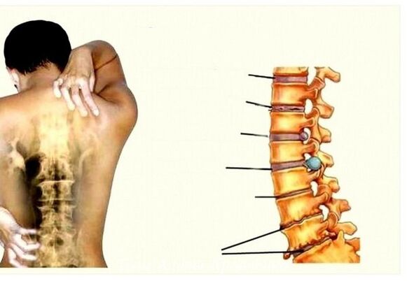 Stadi di osteocondosi cervicale