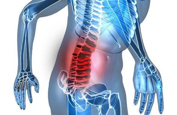 Deformità spinale nel quarto stadio dell'osteocondrosi lombare