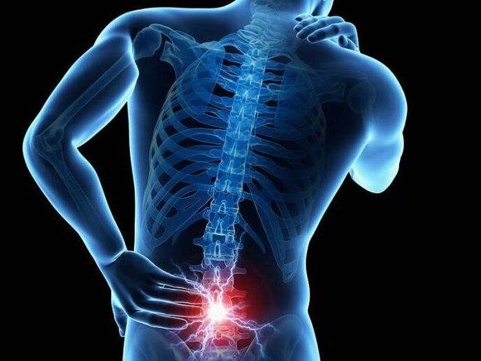Nella radicolite, le radici nervose schiacciate causano un dolore lancinante nella parte bassa della schiena