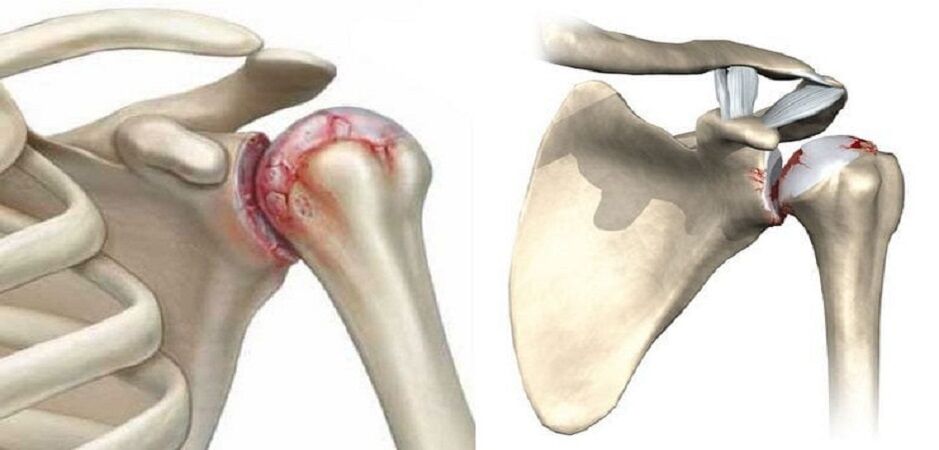 Distruzione dell'articolazione della spalla a causa dell'osteoartrosi