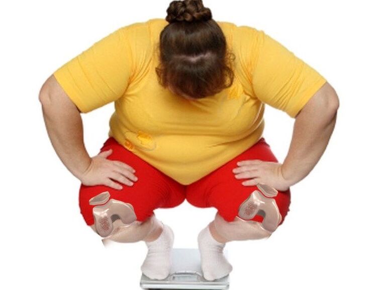 La maggior parte dei pazienti affetti da osteoartrite sono in sovrappeso o obesi