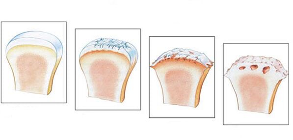 Articolazione sana e 3 gradi di sviluppo dell'osteoartrosi