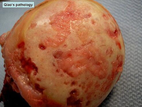 Superficie cartilaginea affetta da osteoartrosi